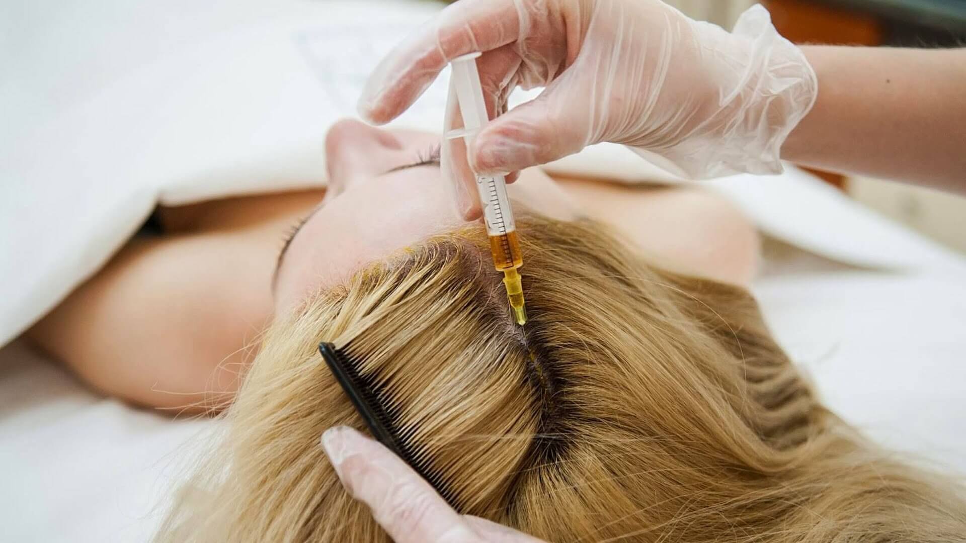 تاثیر مزوتراپی مو چیست؟ بهترین درمان ریزش مو + قیمت و عوارض