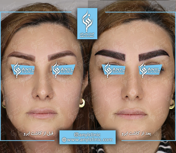 کاشت ابرو با خواب طبیعی