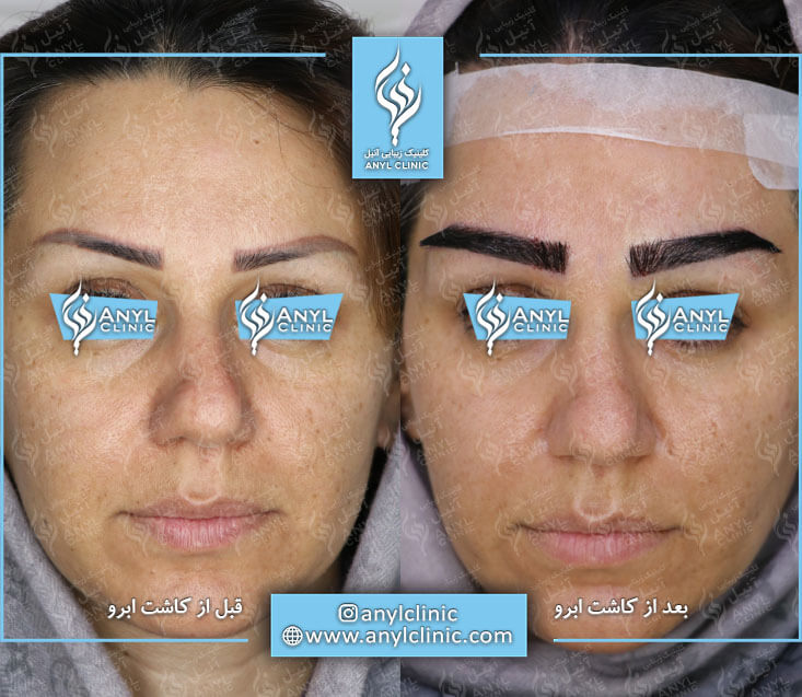 عوارض کاشت ابرو و مژه چیست