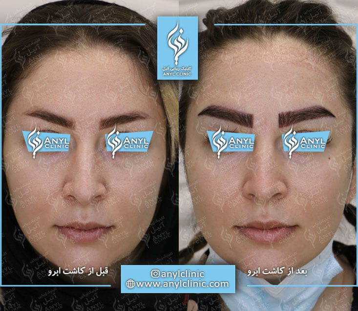 نمونه کاشت ابرو