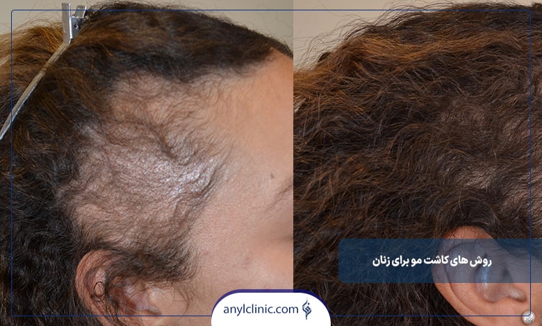 کاشت مو به روش (body hair transplantation) BHT