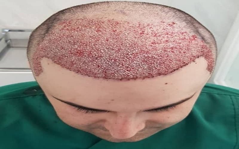 خونریزی بعد از کاشت مو کی متوقف می‌شود؟