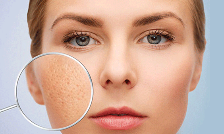 منافذ باز پوست چیست؟ علت منافذ باز پوست + راه های درمان آن