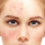 انواع آلرژی پوستی و روش های تشخیص آن