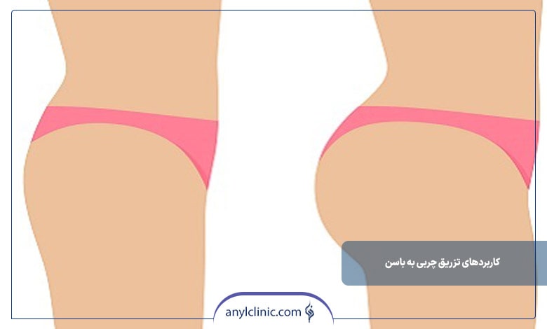 مزایای استفاده از تزریق چربی برای باسن