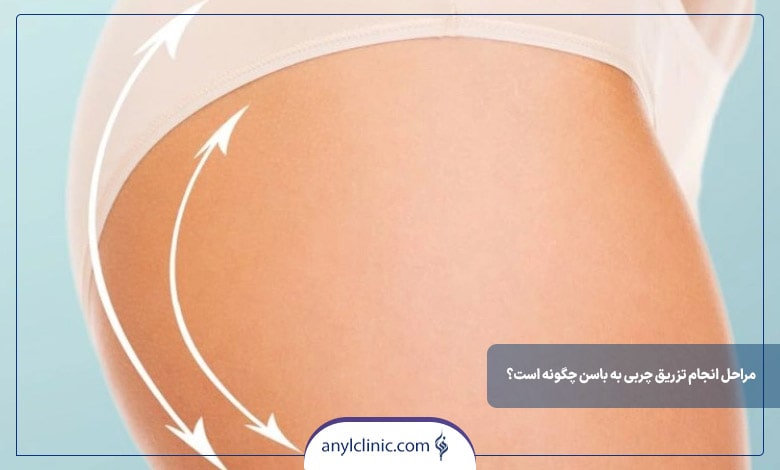مراحل انجام تزریق چربی به باسن چگونه است؟
