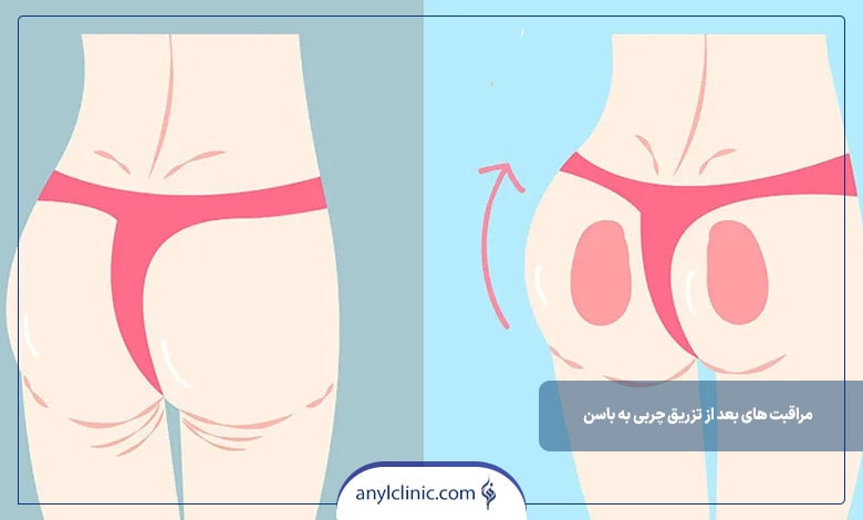 عوارض تزریق چربی به باسن