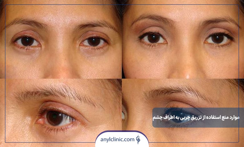 موارد منع استفاده از تزریق چربی به اطراف چشم