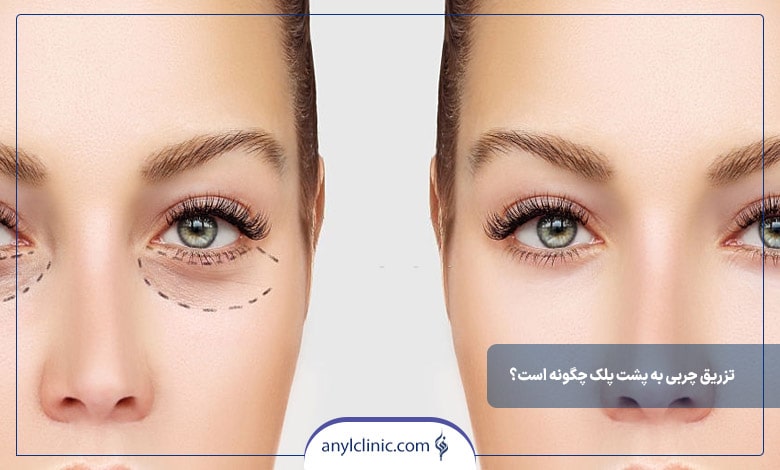 تزریق چربی به پشت پلک چگونه است؟