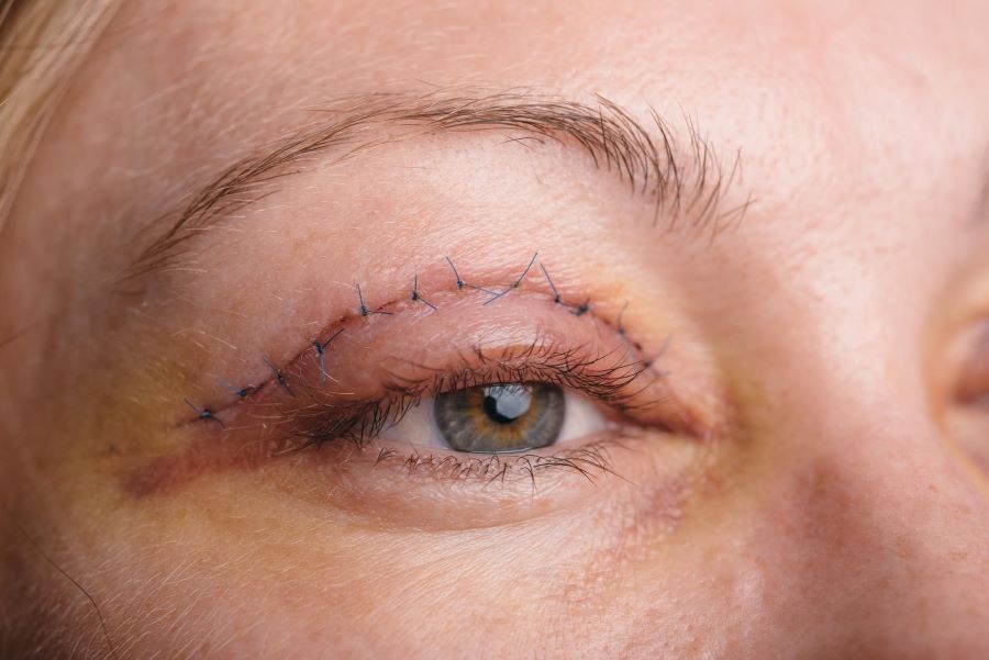 علت کوچک شدن چشم بعد از عمل بلفاروپلاستی