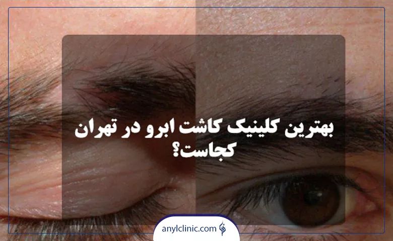 بهترین کلینیک کاشت ابرو در تهران