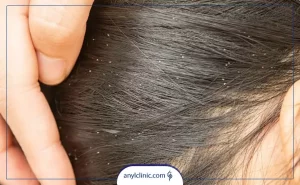 روش های درمان شپش سر