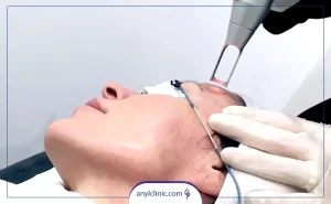 عملکرد لیزر co2 فرکشنال