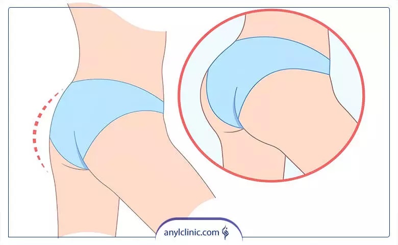 عوارض تزریق چربی به بغل ران پا