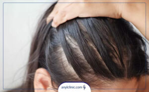 علت ریزش مو در زنان