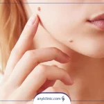برداشتن خال در منزل