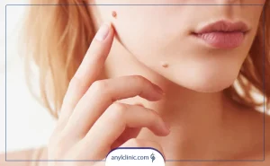 برداشتن خال در منزل