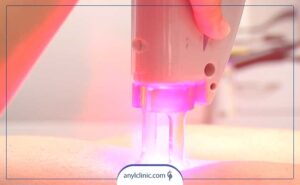 عوارض لیزر بیکینی