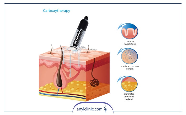 نحوه انجام درمان Carboxytherapy