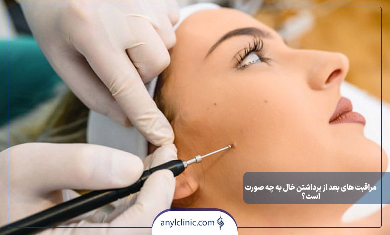 مراقبت های بعد از برداشتن خال به چه صورت است؟