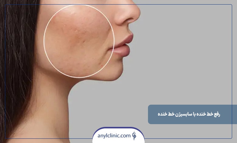 سابسیژن خط خنده روشی موثر برای رفع خط خنده است