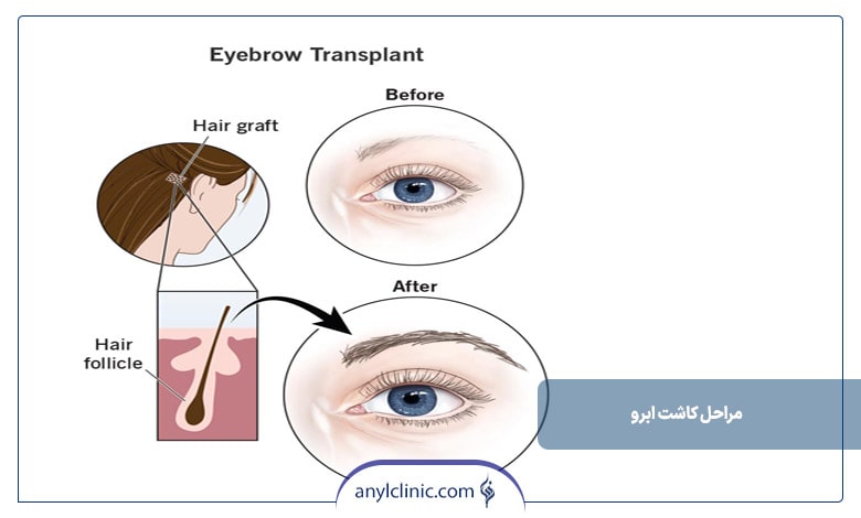 مراحل کاشت ابرو