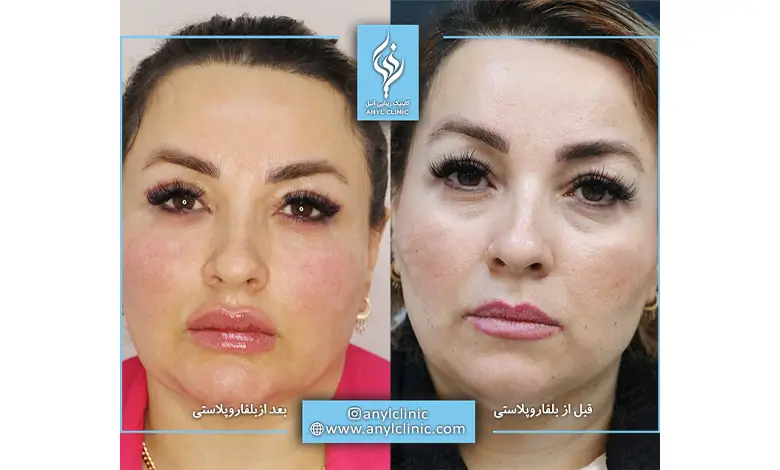 مزایای بلفاروپلاستی یا جراحی پلک چیست