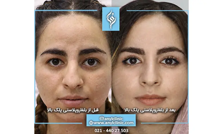 مراقبت های بعد از جراحی پلک