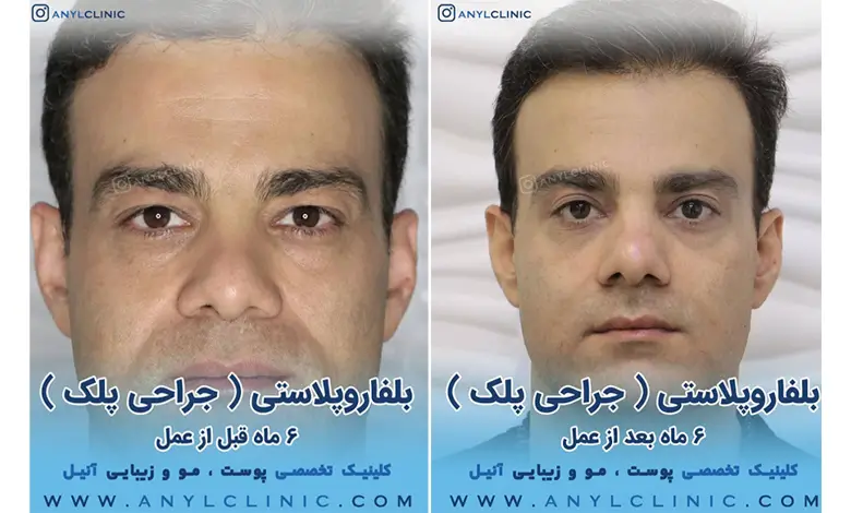عکس قبل و بعد از بلفاروپلاستی