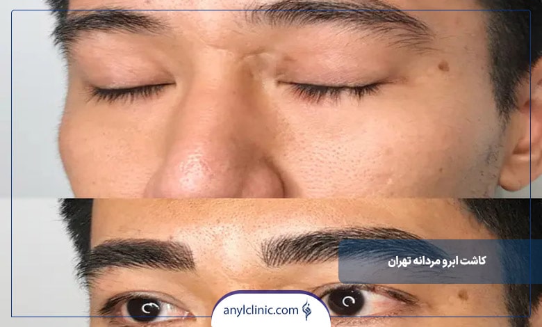 کاشت ابرو مردانه تهران