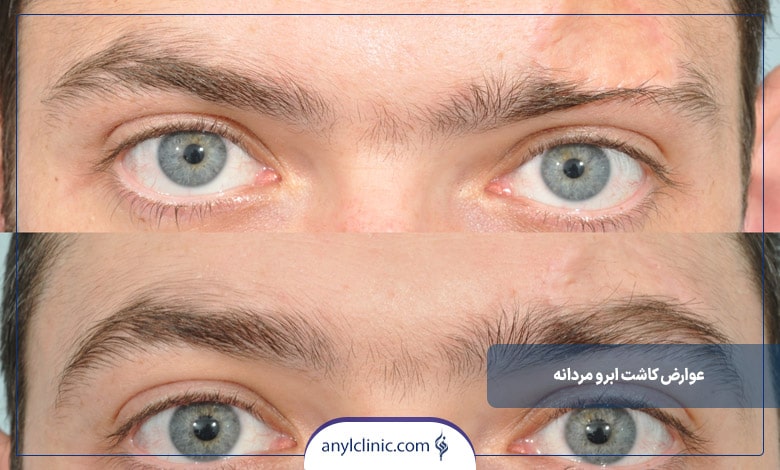 عوارض کاشت ابرو مردانه