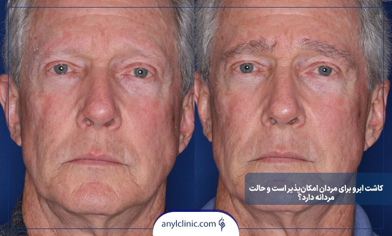 آیا ابروهای کاشتهشده حالت مردانه دارند؟