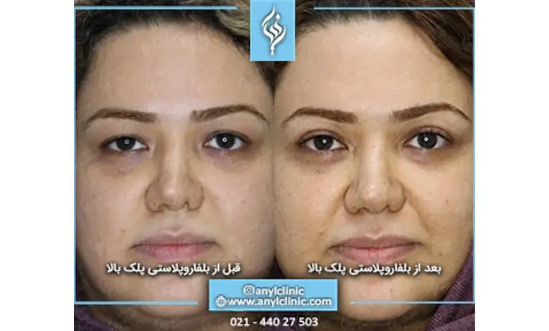 نمونه کار بلفاروپلاستی آنیل